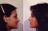 before and after Rhinoplasty