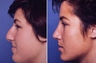 Before and after Rhinoplasty - a beautiful result!