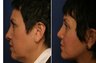 Before and after facelift