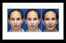 Before & After Seattle Rhinoplasty (Nose job) | Crooked Nose and Chin Augmentation