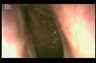 What the inside of the nose looks like | Seattle Septoplasty Surgery | Thomas Lamperti, MD