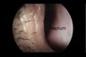 What a deviated nasal septum and enlarged turbinates look like | Thomas Lamperti, MD | Seattle Septoplasty Surgery