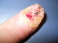 Nailbed Squamous cell carcinoma