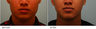 Jaw Reduction with Botox