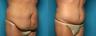 Tummy Tuck: Before and After