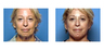 Face Lift: Before & After
