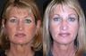 Endoscopic forehead lift before and after