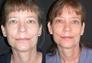 Endoscopic forehead lift with eyelids