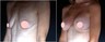 Breast Lift w/Implants