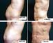 LifeSculpt Liposuction