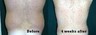 Slim Lipo of Love Handles on Male