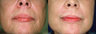 Peri-Oral Before and After