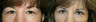 Eyelid Surgery