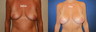 Breast Surgery