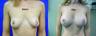 Breast Surgery