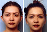 Otoplasty: Before & After