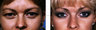 Eyelid Surgery: Before & After