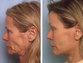 Face-Lift: Before & After