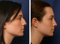 Nose Job: Before & After