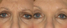 Botox before and after