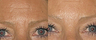 Botox before and after