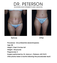 Before and After Abdominoplasty (Tummy Tuck)