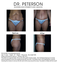 Before and After Abdominoplasty (Tummy Tuck)