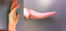 Xiaflex before and after