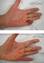 Needle Aponeurotomy
