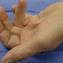 Dupuytrens Disease from assh brochure