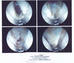 endoscopic carpal tunnel release