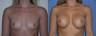 Breast augmentation