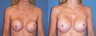 Before and after breast revision surgery