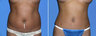 Abdominal liposuction