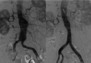 Endograft Repair AAA