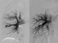 Pulmonary AVM Embolization
