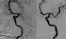 Intracranial Thrombolysis/Thrombectomy for Acute Stroke
