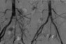 Recanalization and stenting iliac artery occlusion