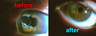 Repair of botched prior cataract surgery