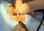congenital cataract surgery for a baby born with cataracts