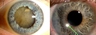 Cataract Surgery: Before & After