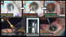 innovations in cataract surgery techniques
