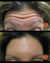 Botox: Before & After