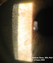 corneal cystinosis