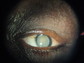 Dense Cataract