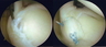 SLAP tear and arthroscopic repair: before and after