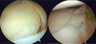 Shoulder Labral Tear Repair: Before and After