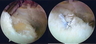 Rotator Cuff Tear Arthroscopic Repair: Before and After