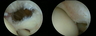 Rotator Cuff Tear Arthroscopic Repair: Before and After
