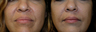 Facial Filler:  Before and After